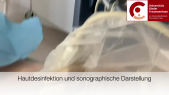 thumbnail of medium Stanzbiopsie bei V.a. Mammakarzinom